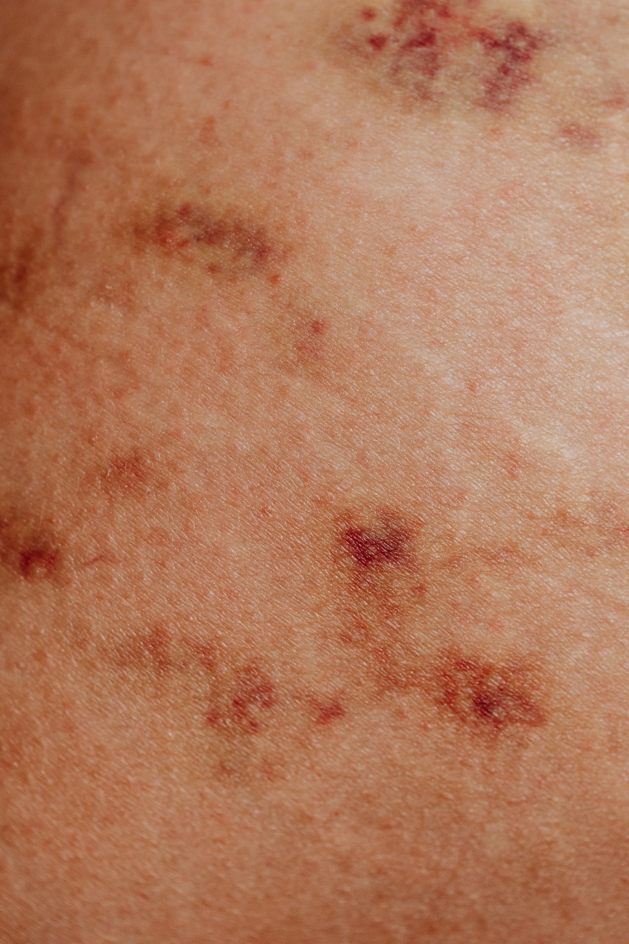 Shingles Vaccine