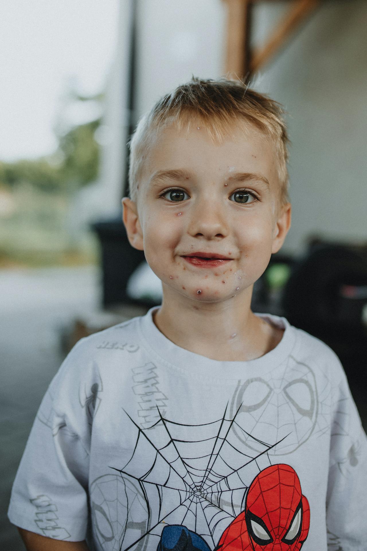 Chickenpox Vaccine