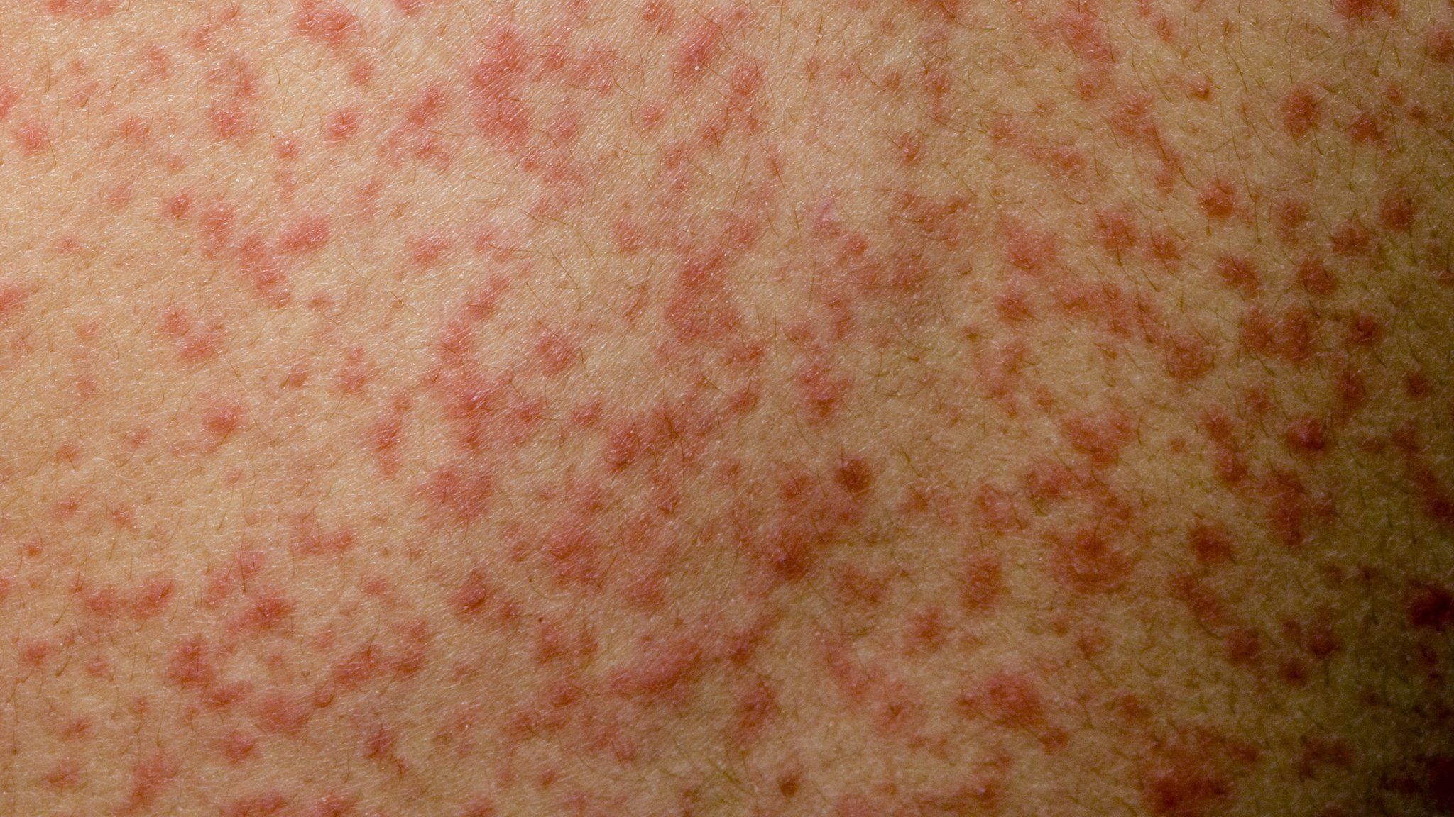 Measles, Mumps and Rubella Manchester travel health illustration showing vaccine and pre-travel support at Manchester Chemist