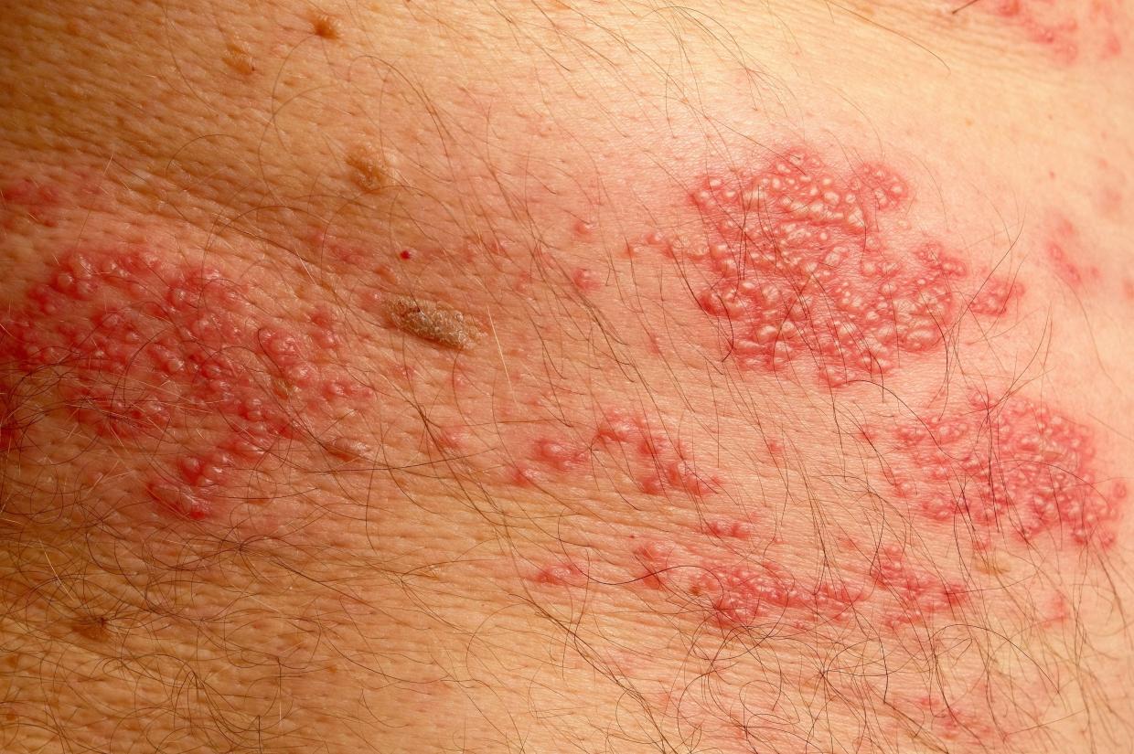 Shingles Manchester travel health illustration showing vaccine and pre-travel support at Manchester Chemist