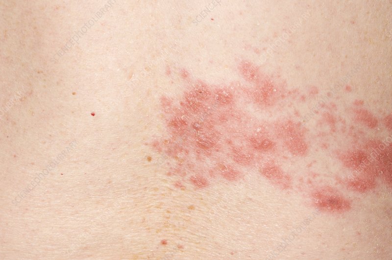 Shingles Vaccine